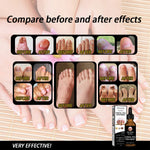 EELHOE Nail Repair Solution – Gray Nail Removal & Brightening Treatment | Beautenaturel