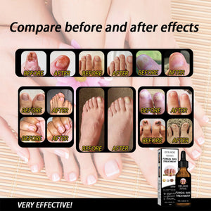 EELHOE Nail Repair Solution – Gray Nail Removal & Brightening Treatment | Beautenaturel